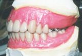 精密義歯横図